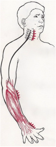  Radiazioni dei sintomi alla spalla o il braccio a causa di neuropatia cervicale