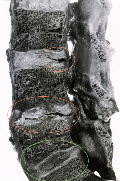 ernia protrusion rachide lombare