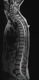 MRI full spine
